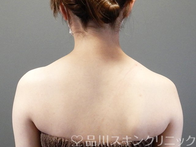 症例NO.66014のAFTER写真