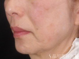 症例NO.73531のBEFORE写真