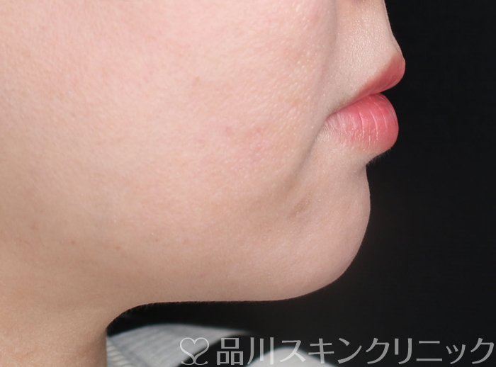 症例NO.73596のBEFORE写真