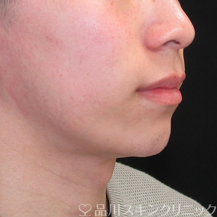 症例NO.73728のAFTER写真