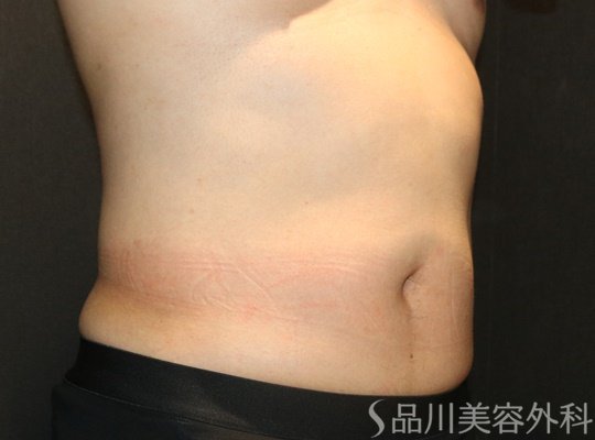 症例NO.71025のAFTER写真