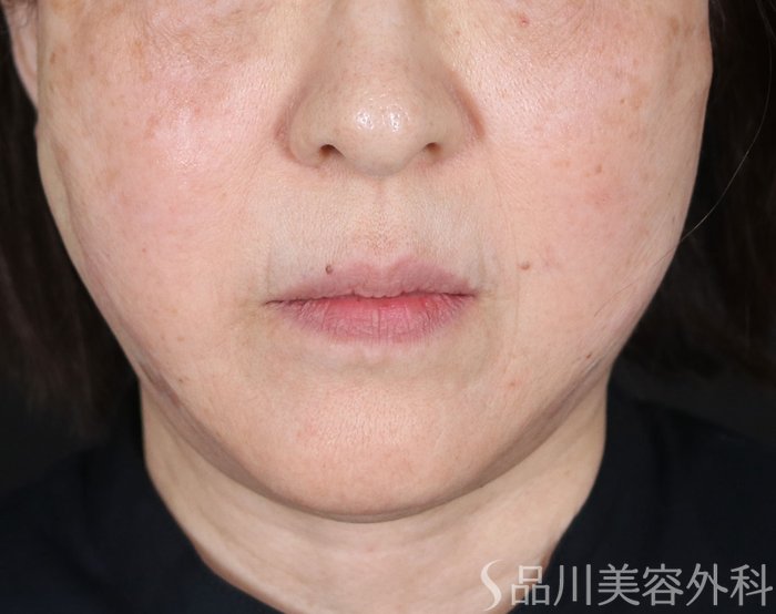 症例NO.72958のAFTER写真