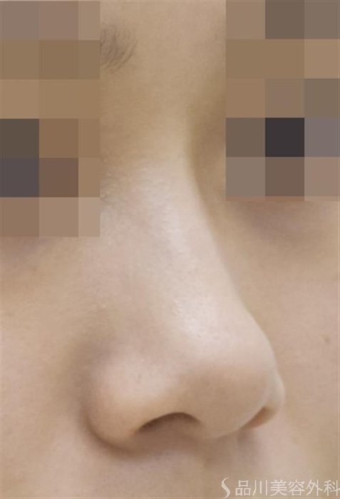 症例NO.47156のBEFORE写真