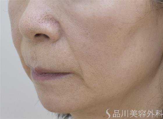 症例NO.49184のBEFORE写真