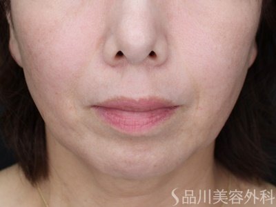 症例NO.70141のAFTER写真