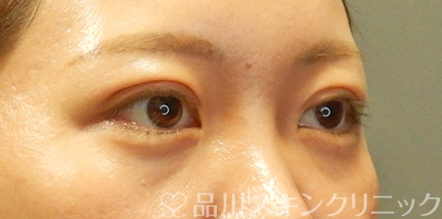症例NO.66571のAFTER写真