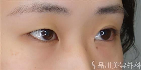 症例NO.50656のBEFORE写真