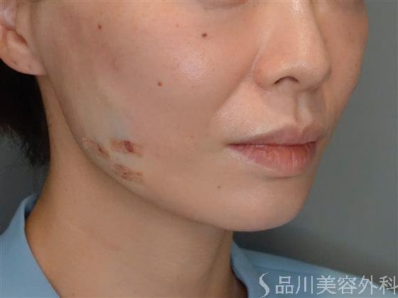 症例NO.51087のAFTER写真