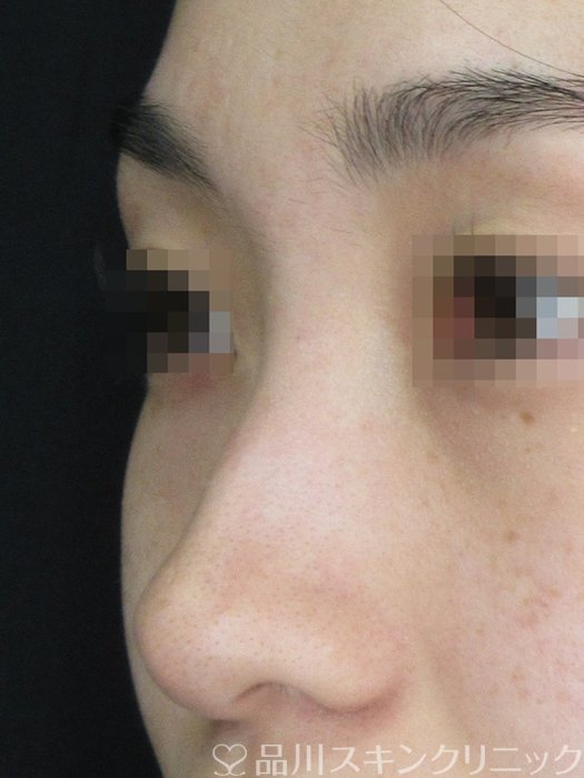 症例NO.67935のBEFORE写真
