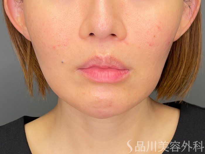 症例NO.65496のBEFORE写真