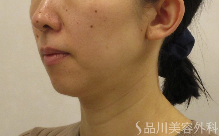 症例NO.62346のBEFORE写真
