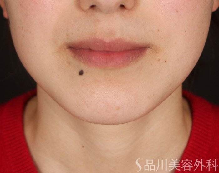 症例NO.73250のBEFORE写真