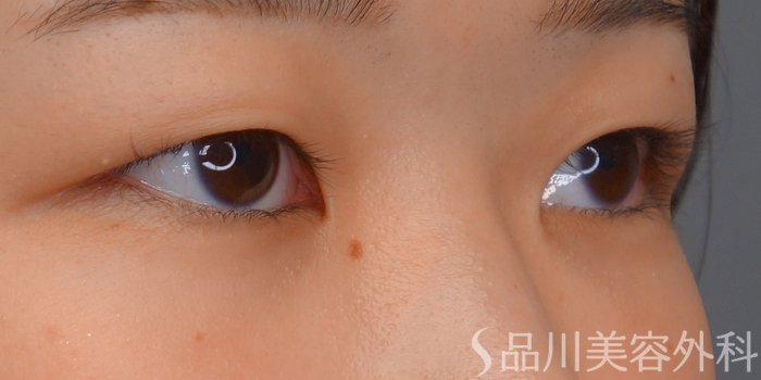 症例NO.72344のBEFORE写真