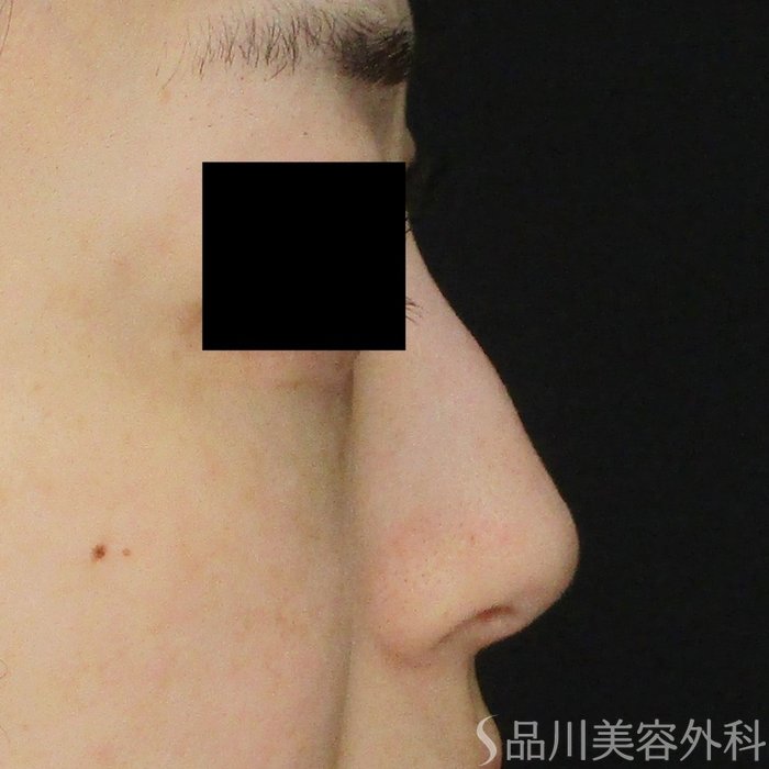 症例NO.70930のBEFORE写真