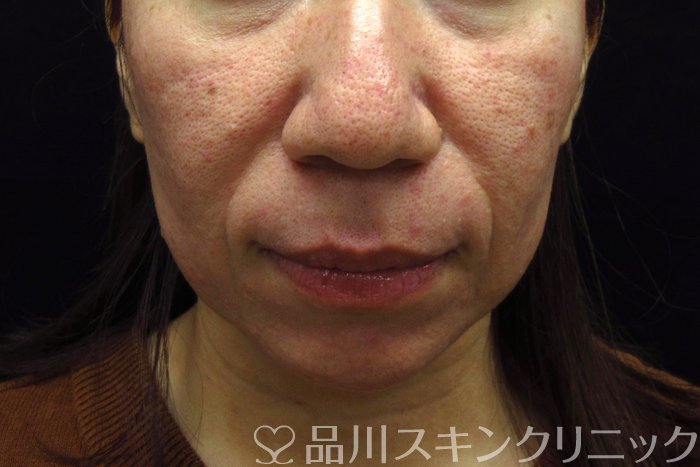 症例NO.74345のBEFORE写真
