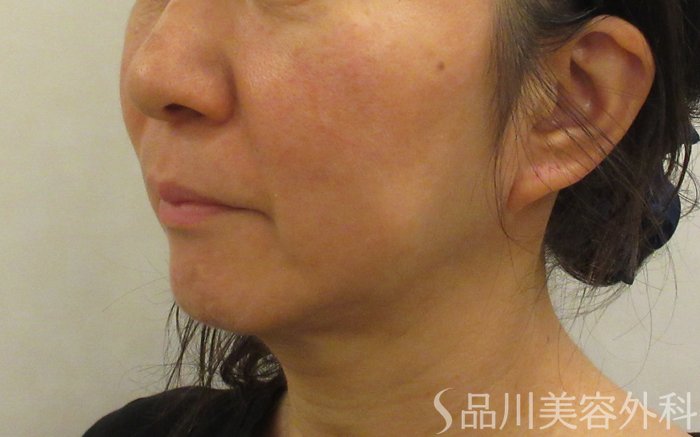 症例NO.70221のBEFORE写真