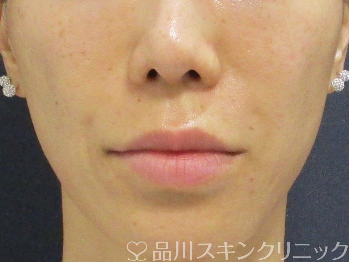 症例NO.74198のAFTER写真