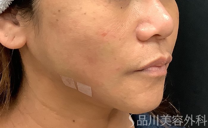 症例NO.69378のAFTER写真