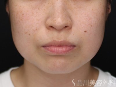 症例NO.71696のBEFORE写真