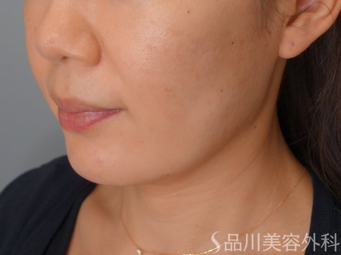 症例NO.70061のBEFORE写真