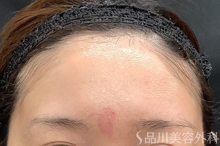 症例NO.71235のBEFORE写真