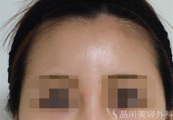 症例NO.46427のAFTER写真