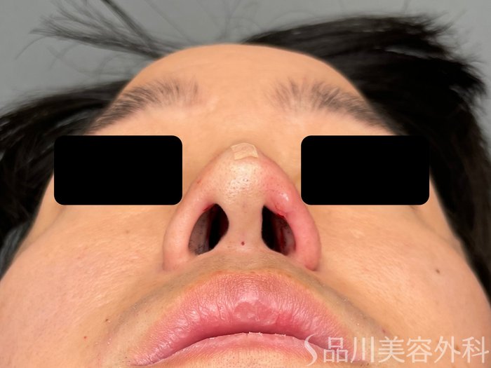 症例NO.73614のAFTER写真