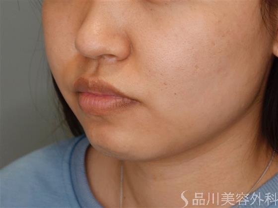 症例NO.51066のBEFORE写真