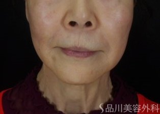 症例NO.72512のAFTER写真