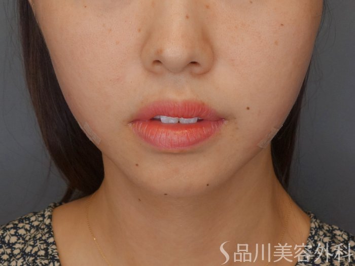 症例NO.71915のAFTER写真