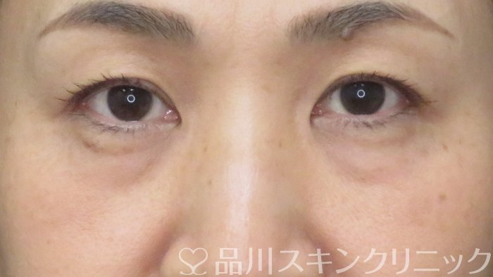 症例NO.72404のBEFORE写真