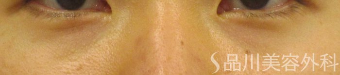 症例NO.65287のBEFORE写真