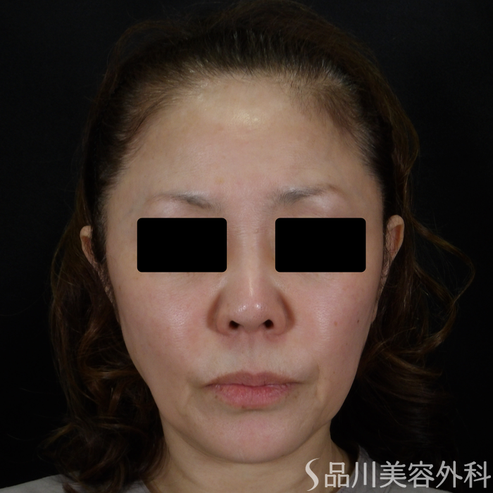 症例NO.72398のBEFORE写真