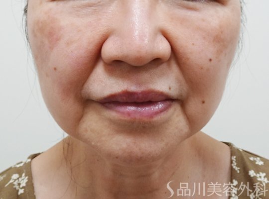 症例NO.73731のBEFORE写真