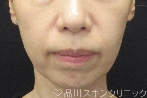 症例NO.64917のBEFORE写真