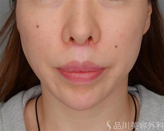 症例NO.54929のBEFORE写真