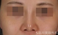 症例NO.71699のBEFORE写真