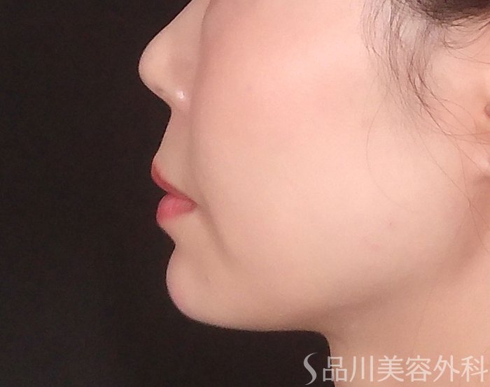 症例NO.70458のAFTER写真