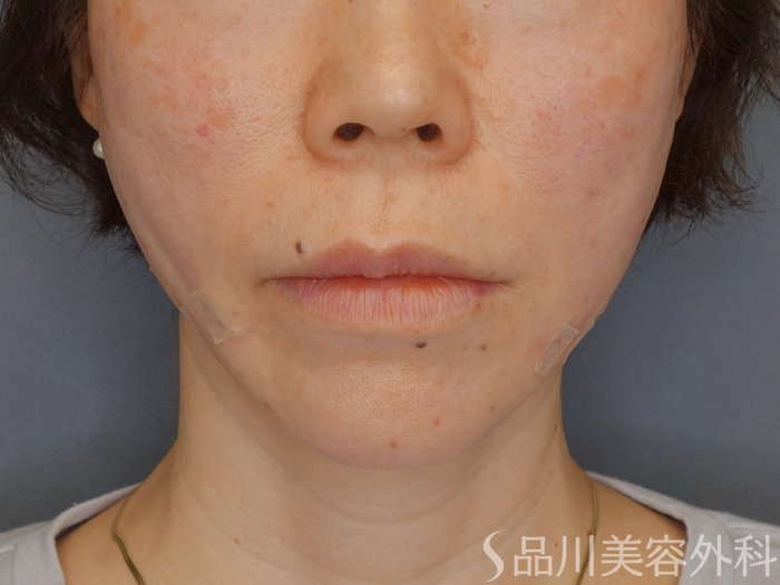 症例NO.72471のAFTER写真