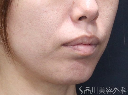 症例NO.75361のBEFORE写真
