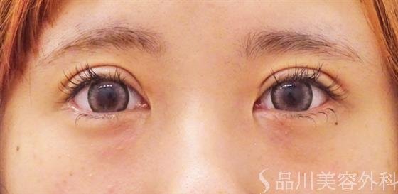 症例NO.54184のAFTER写真
