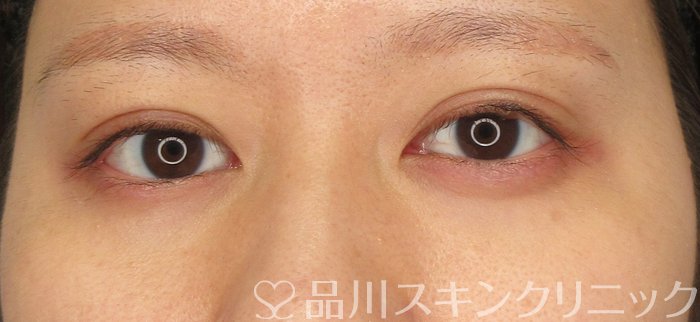 症例NO.70933のAFTER写真