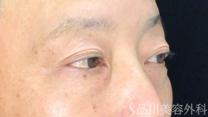 症例NO.71845のBEFORE写真