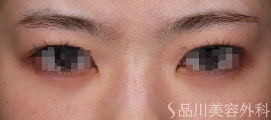 症例NO.69525のBEFORE写真