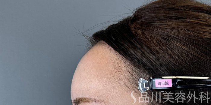 症例NO.73138のAFTER写真