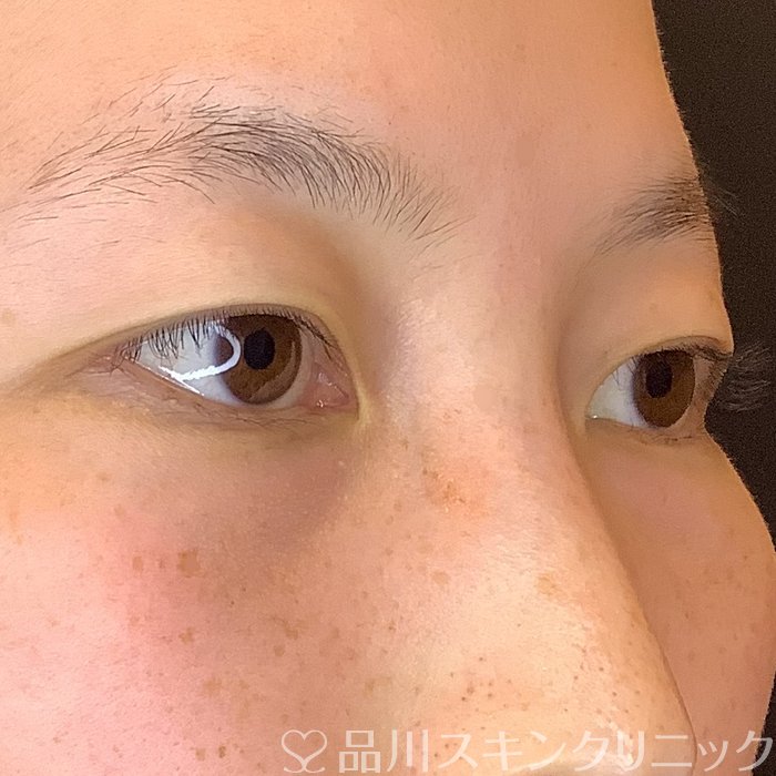 症例NO.62748のBEFORE写真