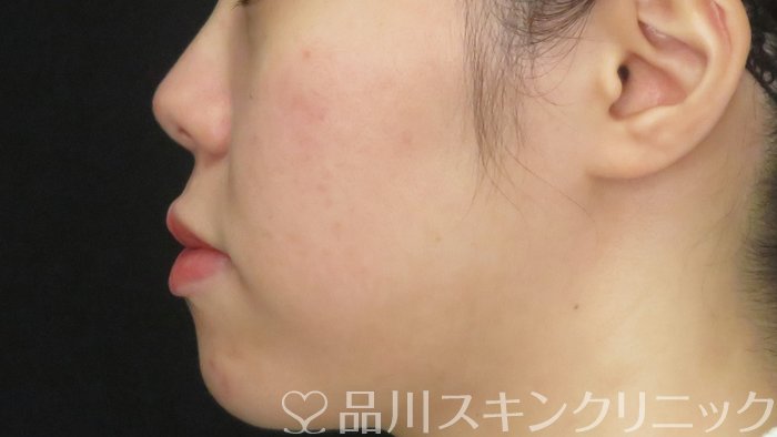 症例NO.71428のAFTER写真