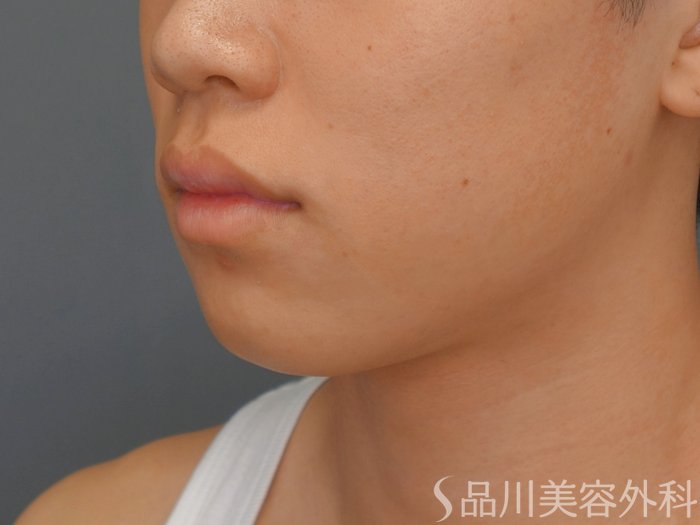 症例NO.74424のBEFORE写真