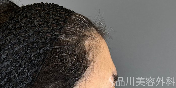 症例NO.69606のBEFORE写真