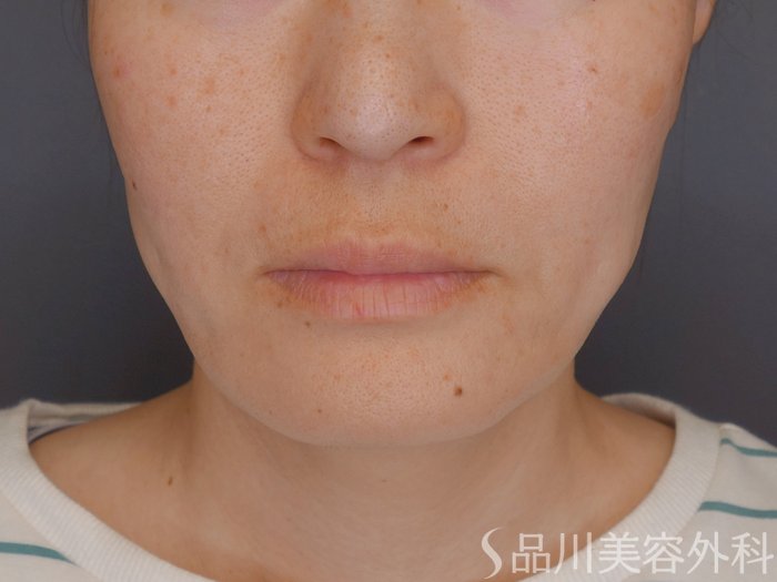 症例NO.72110のBEFORE写真